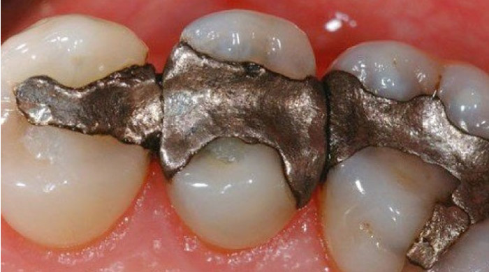 dental cavity filling